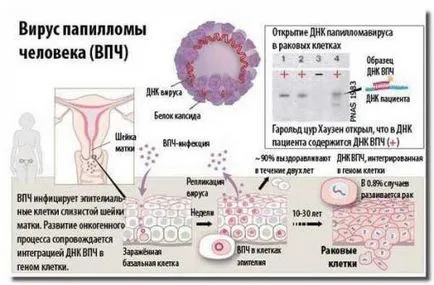 A humán papillomavírus, az oka, hogy hogyan fertőzés tünetei nőknél (férfi) A humán papillomavírus, az oka, hogy hogyan fertőzés tünetei nőknél