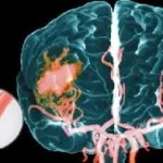 Helyreállítás a stroke otthoni körülmények között a beszéd, memória