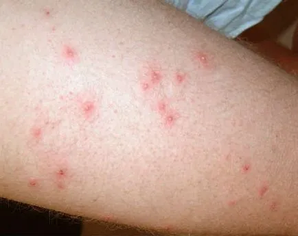 Benőtt szőrszál után szőrtelenítés, hogy megszabaduljon a problémát (szőrtelenítés) Benőtt szőrszál után szőrtelenítés, hogy megszabaduljon a probléma