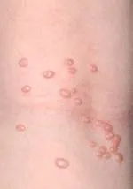 Mindent a molluscum contagiosum és annak kezelése (kagyló) Mindent a molluscum contagiosum és annak kezelése