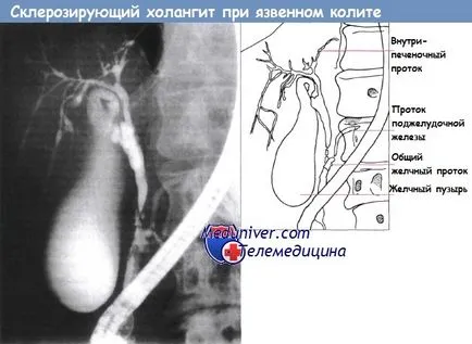 krónikus hepatitis