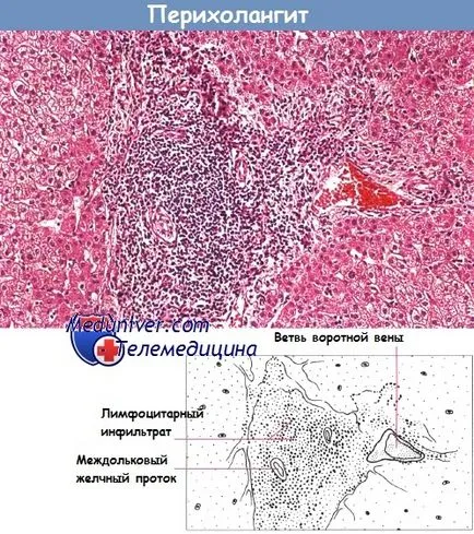 krónikus hepatitis