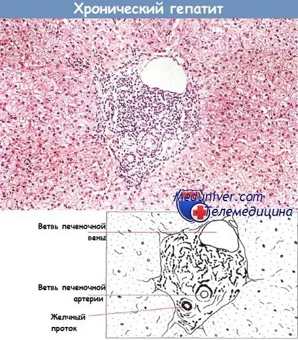krónikus hepatitis