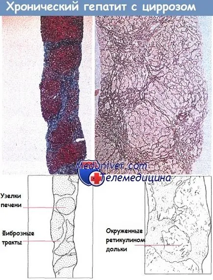 krónikus hepatitis