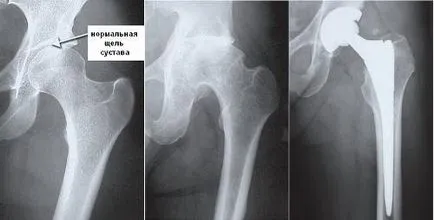 csípőprotézis műtét vélemények