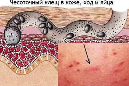 Viszketés az ágyék a tünetek és a kezelés a nők, okoz égő érzés a lágyéki területen (férfiak) Viszketés az ágyék férfiak tünetei és kezelése okoz égő érzés a lágyéki