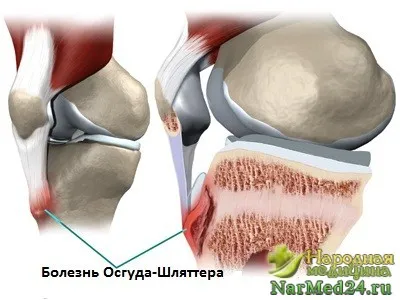 Симптомите на болестта на Shlyattera, знаци и лечение на народната медицина (shlyattera) болестни симптоми, признаци и лечение на народната медицина Shlyattera