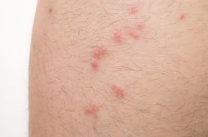 Бълхи при кучета и котки се предават на хората, ако те са опасни