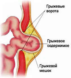 Коремни херния (снимка)
