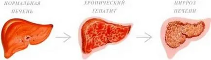 Колко опасен е хепатит С генотип и това, което е най-опасни