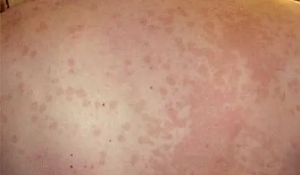 Than за лечение chromophytosis снимка, лечение, ревюта