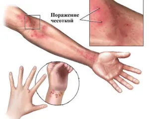 Краста симптоми, лечение, симптоми при възрастни (симптоми) Краста симптоми, лечение, симптоми при възрастни