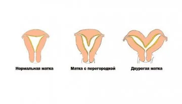 Soft méh, hogy ez Soft méh, hogy ez