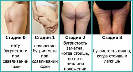 Anti-cellulit maszkok otthon Anti-cellulit maszkok otthon