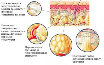 Anti-cellulit maszkok otthon Anti-cellulit maszkok otthon