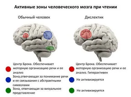 Дислексия - патология, или елемент, който искате да се научите как да се контролира