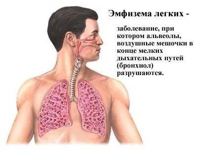 Емфизем причини, признаци, симптоми, лечение