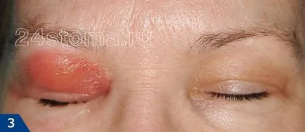 Ethmoiditis - симптоми и лечение при възрастни, антибиотици, капки