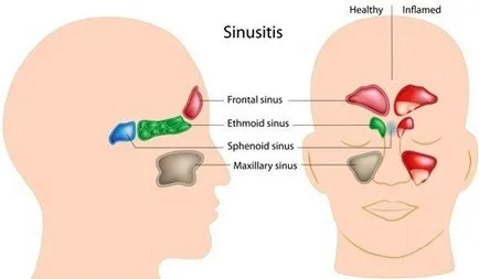 Ethmoiditis симптоми и лечение