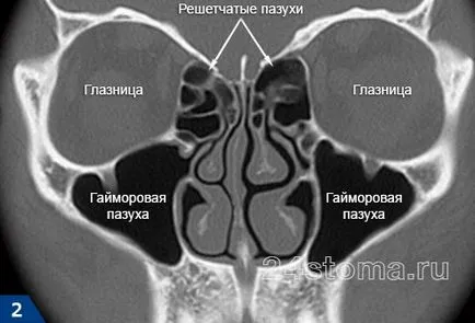Ethmoiditis - симптоми и лечение при възрастни, антибиотици, капки