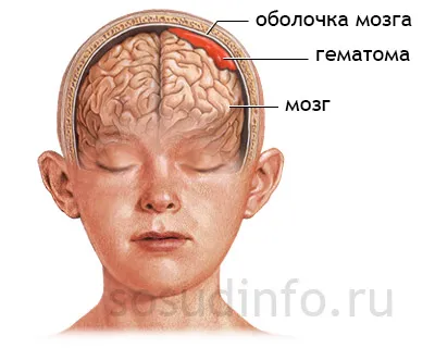 Хипертонична синдром, hydrocephalic деца и възрастни