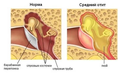 Гнойни възпаления на средното ухо - причини, симптоми, симптоми и лечение
