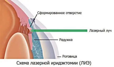 Глаукома - какво е за лечение, независимо дали вродени, диагностика, причинява, капки за очи,