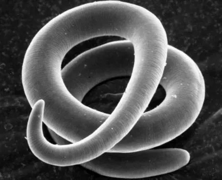 Worms в предната част на снимка човек, симптоми, лечение