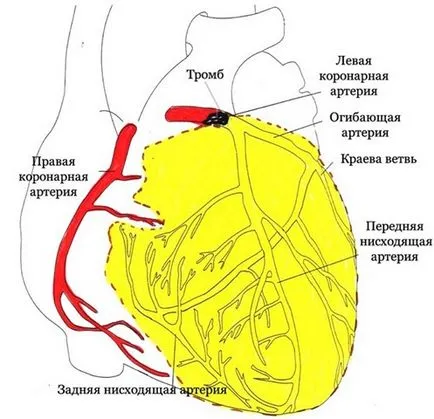 Симптомите на миокарден инфаркт и лечение (лечение) Миокардните симптоми и лечение на миокарда