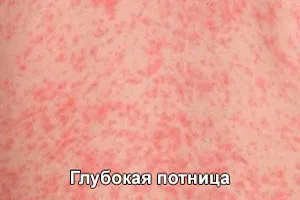 Как да се лекува бодлив топлина бебе (снимки)
