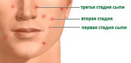 Как да се разграничи от варицела от алергии в снимка на детето, маса за сравнения (кожата на обрива) Как да се разграничи от варицела от алергии в снимка на детето, маса за сравнения