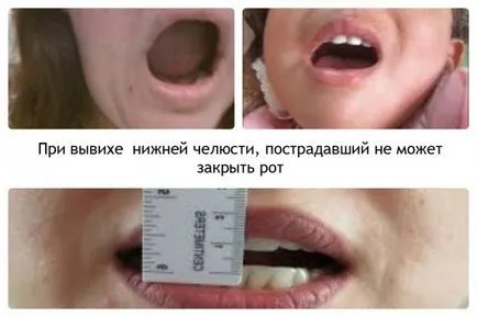 Какви са симптомите на разместване на челюстта, и как за лечение на челюстта, във видеото - препозициониране на челюстта (лечение) Какви са симптомите на разместване на челюстта, и как за лечение на на челюстта, във видеото - препозициониране на челюстта