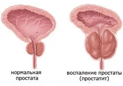 Как да се подготвим за простатата и пикочния мехур ултразвук