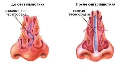 Hogyan erősít az orrsövény