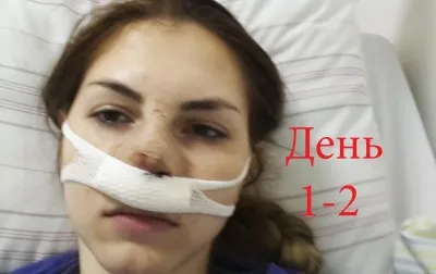 Hogyan erősít az orrsövény