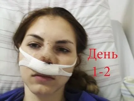 Hogyan erősít az orrsövény