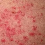 Как да премахнете пъпки по ръцете на народната медицина