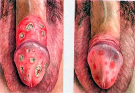 Candida баланопостит при мъжете причини, симптоми, лечение, снимки