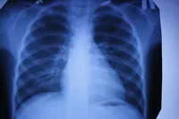 A zárt forma tuberkulózis, hogy ez