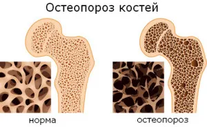 Mi a csontritkulás a csont Mi a csontritkulás a csont
