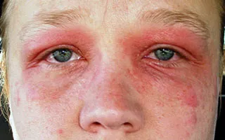 Hogyan lehet eltávolítani allergia Hogyan lehet eltávolítani allergia