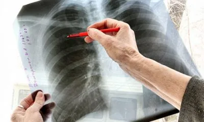 A zárt forma tuberkulózis, hogy ez A zárt forma tuberkulózis, hogy ez