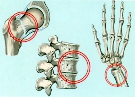 Mi a csontritkulás a csont Mi a csontritkulás a csont