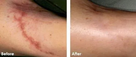 Cryospray