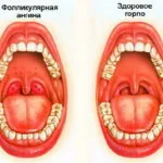 Лечение на фоликуларен тонзилит, както и за лечение, отколкото
