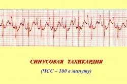 тахикардия лечение народната медицина у нас