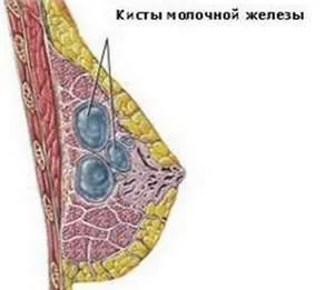 Лечение народни средства за защита на гърдата възлова мастопатия, дифузна и кистозна фиброзни (популярен) Лечение народни средства за защита на гърдата възлова мастопатия, дифузна и фиброкистозна