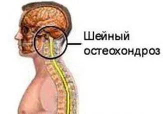 Кинезитерапия при остеохондроза на шийните прешлени, причинява симптомите, диагностиката, (шийката на матката) Кинезитерапия при остеохондроза на шийните прешлени, причинява симптомите, диагностиката,