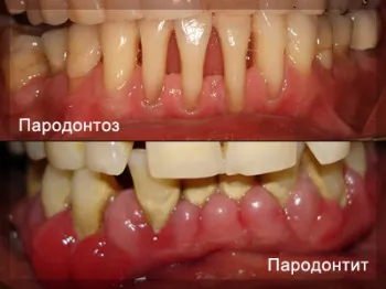 периодонтално заболяване лечение у дома (домашно лечение на пародонтоза) периодонтално заболяване лечение у дома