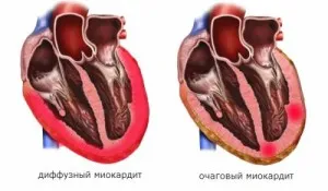 Миокардит симптоми, лечение, диагностика, причини, превенция, здравето азбука